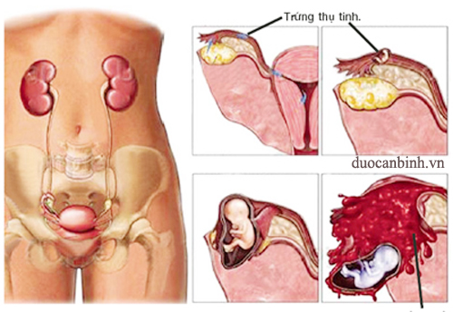 Chảy máu âm đạo thai kỳ - Hình ảnh minh họa